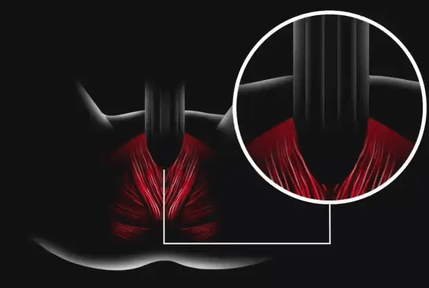 VHFV - תנודה מכנית בתדר גבוה על שריר רצפת האגן